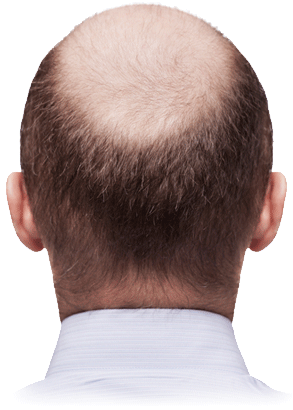 Male Baldness Pattern