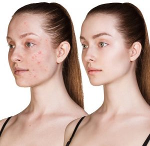ClearPores Before and After