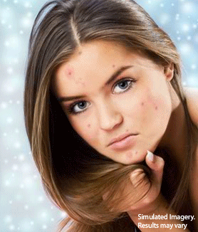 How Clearpores work for a flawless skin