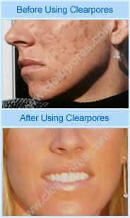 ClearPores testimonails