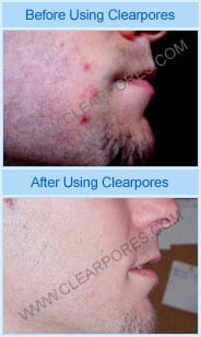 ClearPores Before and After Results